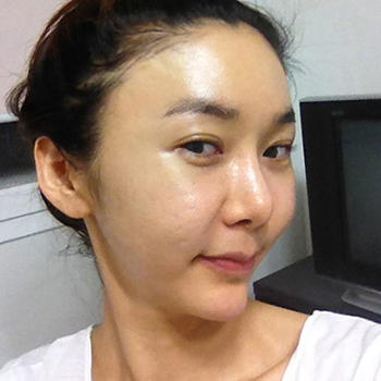 周口華美整形醫(yī)院翟紅光醫(yī)生做面部除皺效果怎么樣？附案例效果對比圖