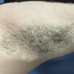廈門張銘整醫(yī)療整形醫(yī)生張小玲做激光脫腋毛怎么樣？附激光脫腋毛效果對(duì)比圖