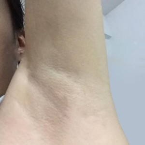 廈門張銘整醫(yī)療整形醫(yī)生張小玲做激光脫腋毛怎么樣？附激光脫腋毛效果對(duì)比圖