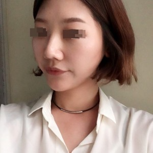 太原麗都整形醫(yī)院劉晉艷醫(yī)生做光纖溶脂瘦臉怎么樣？附案例效果對比圖