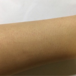 鄭州屈小麗醫(yī)療整形醫(yī)院醫(yī)生劉丹做手臂脫毛怎么樣？附手臂脫毛案例