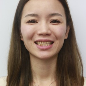安慶渡江口腔醫(yī)院張良斌醫(yī)生牙齒貼面怎么樣？附牙齒貼面效果圖