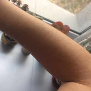 鄭州屈小麗醫(yī)療整形醫(yī)院醫(yī)生劉丹做手臂脫毛怎么樣？附手臂脫毛案例