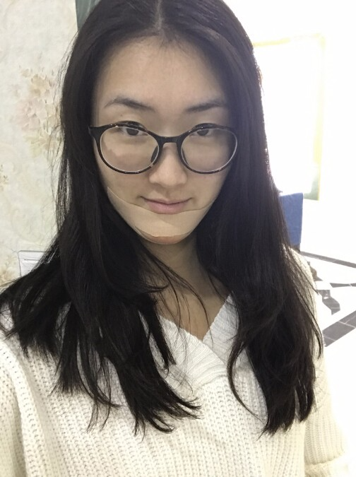 武漢中翰整形外科醫(yī)院做硅膠墊下巴怎么樣？附朱紅霞醫(yī)生案例效果對比圖