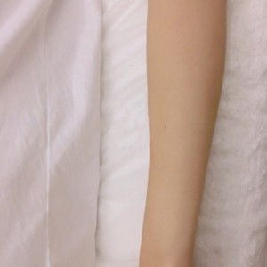 鄭州屈小麗醫(yī)療整形醫(yī)院醫(yī)生劉丹做手臂脫毛怎么樣？附手臂脫毛案例