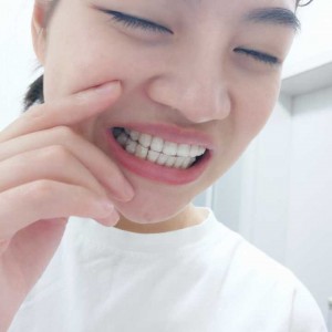 廈門拜博口腔醫(yī)院醫(yī)生張忠做牙齒隱形矯正怎么樣？附案例效果對比圖