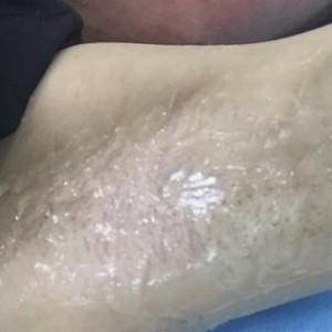 廈門張銘整醫(yī)療整形醫(yī)生張小玲做激光脫腋毛怎么樣？附激光脫腋毛效果對比圖