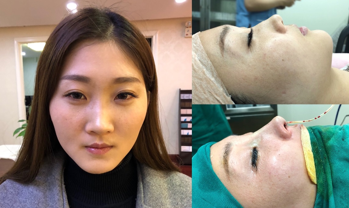 上海首爾麗格醫(yī)療美容醫(yī)院醫(yī)生樸晟秀做膨體隆鼻怎么樣？附案例效果圖