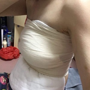 佛山東方女子醫(yī)院整形美容中心姜政輝做自體脂肪隆胸案例效果對(duì)比圖