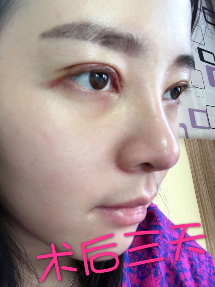 北京京韓整形醫(yī)生王義山做埋線雙眼皮怎么樣？附案例效果對(duì)比圖