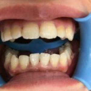 洛陽友好口腔醫(yī)院醫(yī)生楊愛芳做牙齒冷光美白怎么樣？附案例效果圖