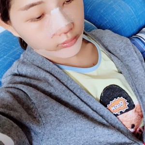 北京京民醫(yī)院整形外科醫(yī)生李鴻儒做硅膠隆鼻怎么樣？附案例效果圖