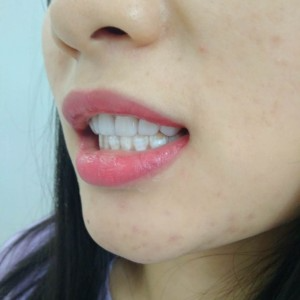 洛陽友好口腔醫(yī)院醫(yī)生李新然做牙貼面怎么樣？附案例效果圖