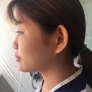 北京京民醫(yī)院整形外科醫(yī)生李鴻儒做硅膠隆鼻怎么樣？附案例效果圖