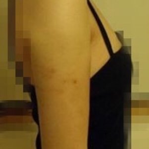 岳陽愛思特醫(yī)療美容醫(yī)院醫(yī)生王福生做手臂吸脂怎么樣？附案例效果圖