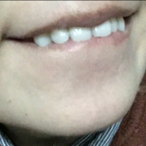 洛陽友好口腔醫(yī)院醫(yī)生楊愛芳做牙齒冷光美白怎么樣？附案例效果圖