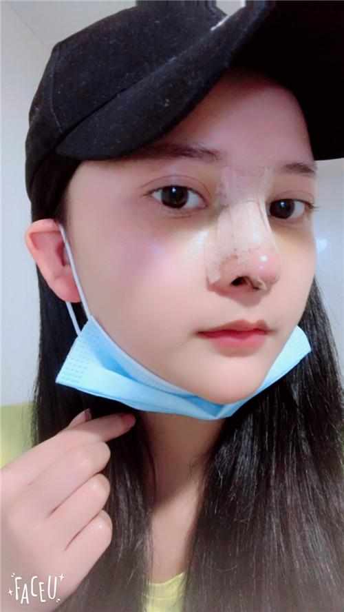 鄭州華領(lǐng)醫(yī)療美容醫(yī)院醫(yī)生張永濤做硅膠假體隆鼻怎么樣？附案例效果對(duì)比圖