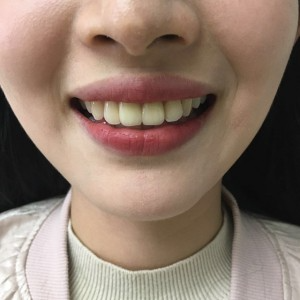 上?？仆呖谇会t(yī)院醫(yī)生鄧建儒做牙齒冷光美白怎么樣？附案例效果對(duì)比圖