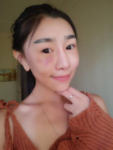 貴陽泰康樂醫(yī)院整形美容科醫(yī)生陳璐做自體脂肪全臉填充效果怎么樣？