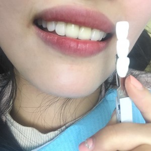 上?？仆呖谇会t(yī)院醫(yī)生鄧建儒做牙齒冷光美白怎么樣？附案例效果對比圖