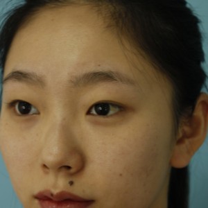 鄭州安格潤整形醫(yī)生楊曉紅做雙眼皮手術怎么樣？附案例效果圖