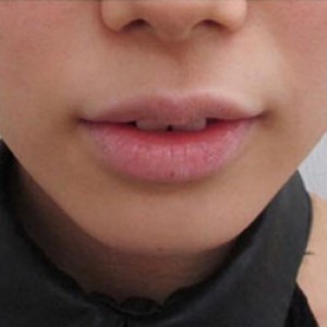 蚌埠韓美美萊整形醫(yī)院醫(yī)生張濤做玻尿酸墊下巴怎么樣？來看案例效果圖