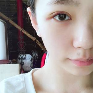 鄭州安格潤整形醫(yī)生楊曉紅做雙眼皮手術怎么樣？附案例效果圖