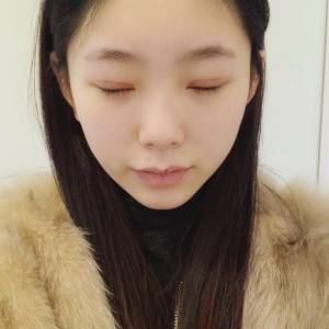 鄭州安格潤整形醫(yī)生楊曉紅做雙眼皮手術怎么樣？附案例效果圖