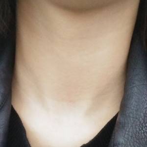 昭通愛(ài)麗諾整形醫(yī)生陳志江做嗨體去頸紋怎么樣？附案例效果圖