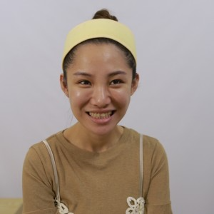 保定東陽口腔醫(yī)院醫(yī)生白小青做牙齒冷光美白怎么樣？附案例效果對(duì)比圖