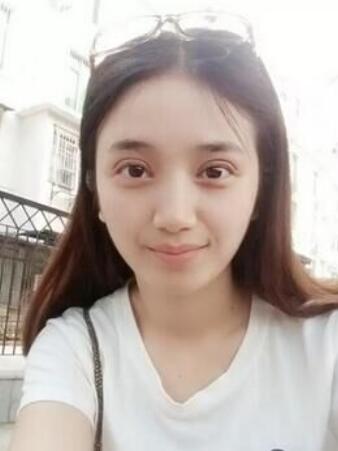 長治松禾醫(yī)療美容診所醫(yī)生馬俊峰做韓式微創(chuàng)定點(diǎn)雙眼皮效果怎么樣？附案例