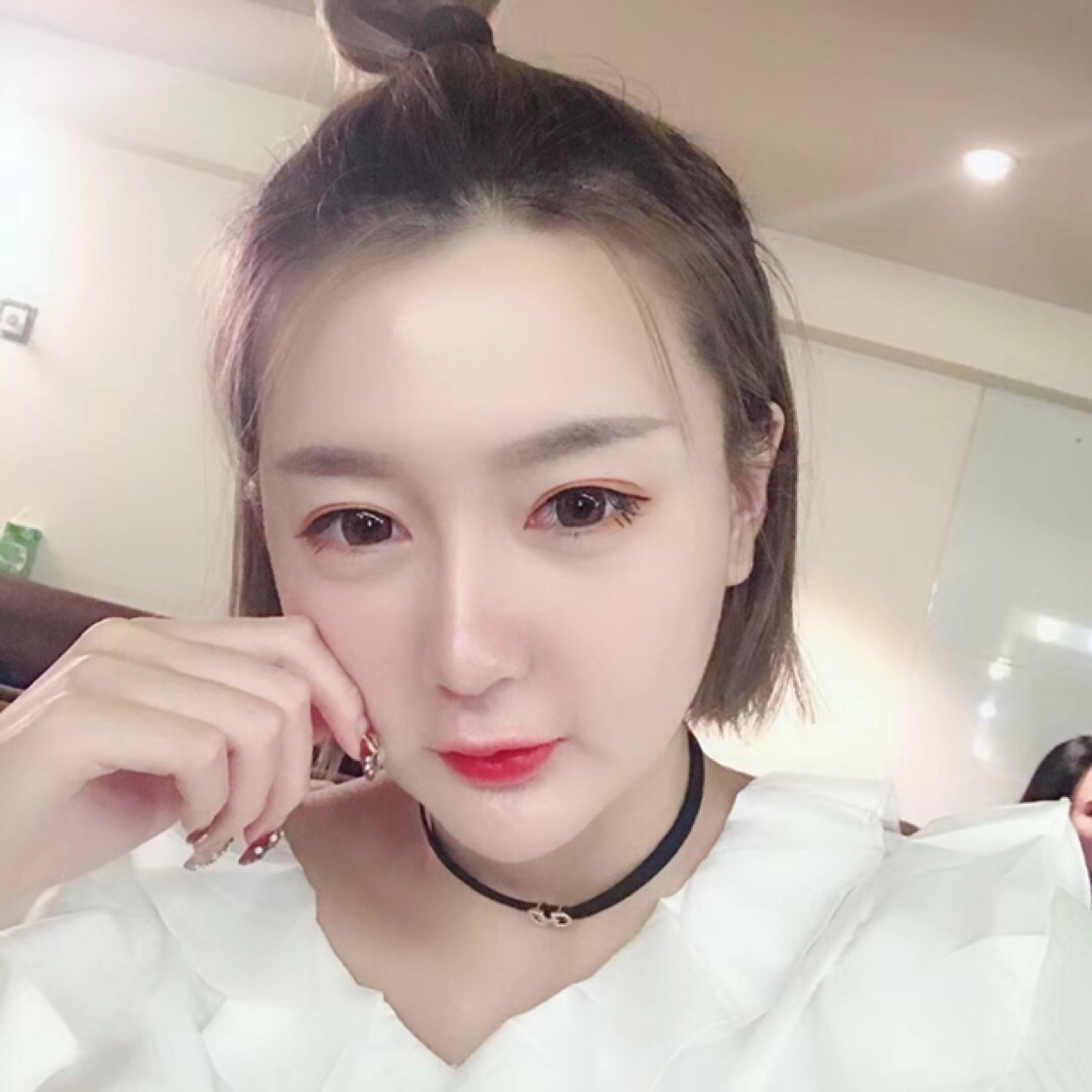 杭州格萊美整形美容醫(yī)院醫(yī)生張霞飛做自體脂肪全臉填充效果怎么樣？