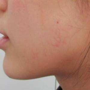 蚌埠韓美美萊整形醫(yī)院醫(yī)生張濤做玻尿酸墊下巴怎么樣？來(lái)看案例效果圖