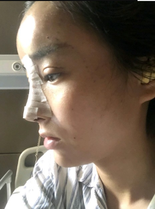 武漢米蘭醫(yī)療美容醫(yī)生柳再億做眼綜合+鼻綜合整形怎么樣？附真實(shí)案例對(duì)比圖
