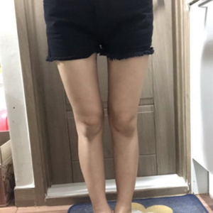 貴陽(yáng)華美整形美容醫(yī)院醫(yī)生田永華做大腿吸脂效果怎么樣？附大腿吸脂案例前后對(duì)比圖