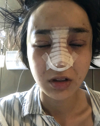 武漢米蘭醫(yī)療美容醫(yī)生柳再億做眼綜合+鼻綜合整形怎么樣？附真實(shí)案例對(duì)比圖