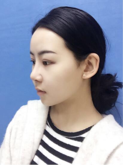 上海時(shí)光整形外科醫(yī)院醫(yī)生李靜林做假體隆鼻和反頜手術(shù)怎么樣？
