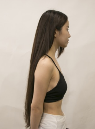 吉林現(xiàn)代整形美容醫(yī)院做假體隆胸效果怎么樣？附醫(yī)院案例效果對比圖