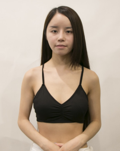吉林現(xiàn)代整形美容醫(yī)院做假體隆胸效果怎么樣？附醫(yī)院案例效果對(duì)比圖