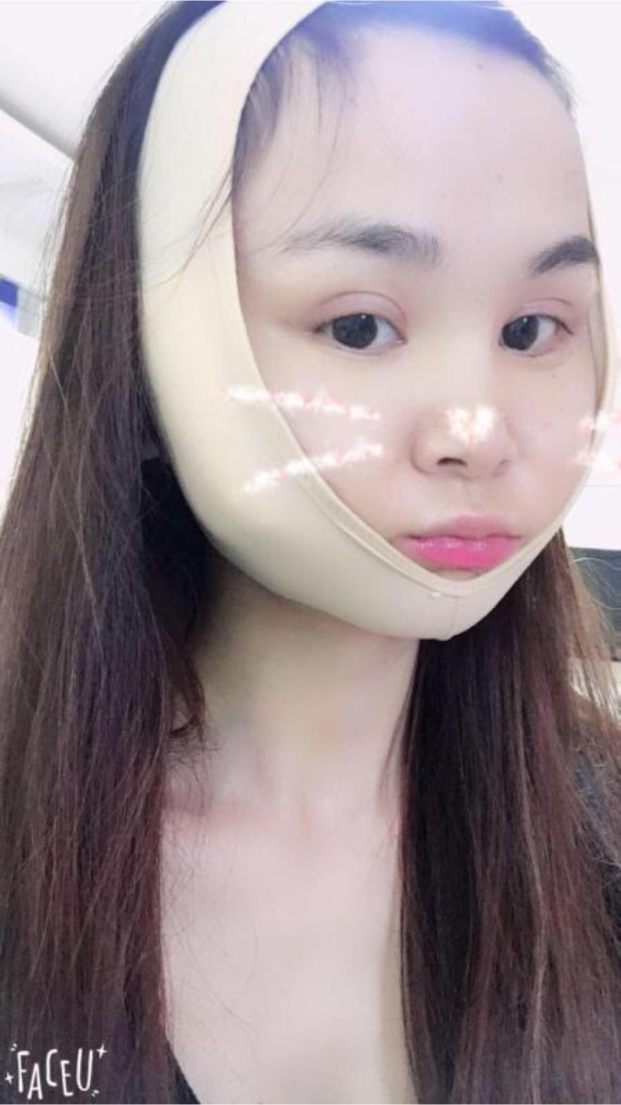 北京彤美美容整形醫(yī)院醫(yī)生楊曉惠做顴骨內(nèi)推+面部吸脂手術(shù)效果怎么樣？附案例