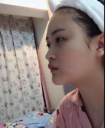 北京伊美爾美容愛康醫(yī)院醫(yī)生柳成做鼻綜合整形怎么樣？附案例效果圖