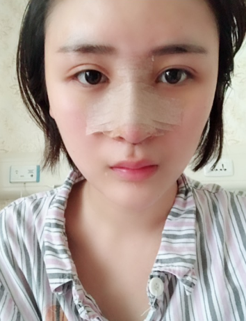 北京伊美爾美容愛康醫(yī)院醫(yī)生柳成做鼻綜合整形怎么樣？附案例效果圖