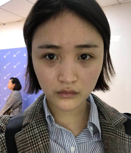 北京伊美爾美容愛康醫(yī)院醫(yī)生柳成做鼻綜合整形怎么樣？附案例效果圖