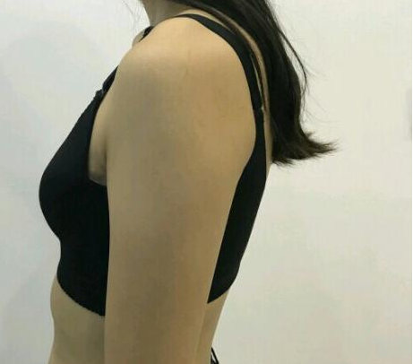 武漢伽美醫(yī)療美容醫(yī)院醫(yī)生朱富初做自體脂肪隆胸怎么樣？看案例