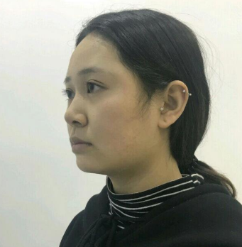 上海時(shí)光整形醫(yī)院做豐下巴怎么樣？許黎平醫(yī)生豐下巴案例分享