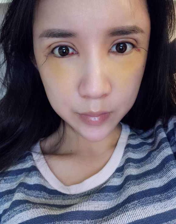 上海時(shí)光整形醫(yī)院張晶醫(yī)生做開(kāi)眼角怎么樣？附真實(shí)效果圖