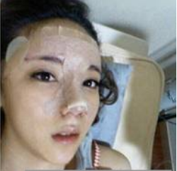 上海時(shí)光整形醫(yī)生何晉龍做假體隆鼻效果怎么樣？附案例效果對(duì)比圖