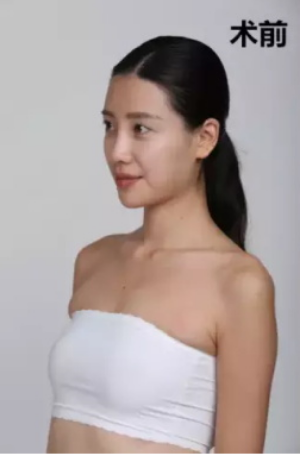 上海時光整形醫(yī)院何晉龍醫(yī)生做假體隆胸怎么樣？附案例對比圖