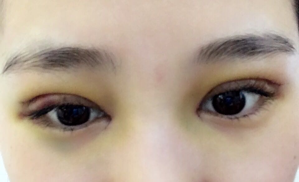 蚌埠韓美美萊整形醫(yī)生鄭捷做開眼角怎么樣？附案例效果圖
