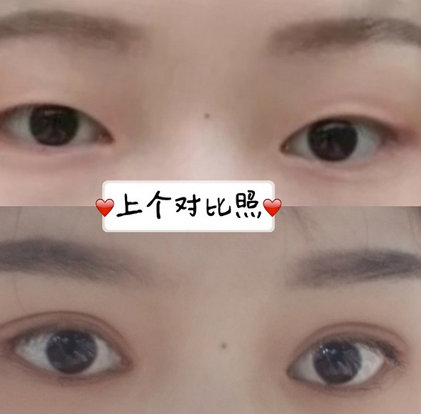 鞍山菲之都醫(yī)療整形醫(yī)院做開(kāi)眼角+全切雙眼皮效果怎么樣？附藺嬌婷醫(yī)生案例
